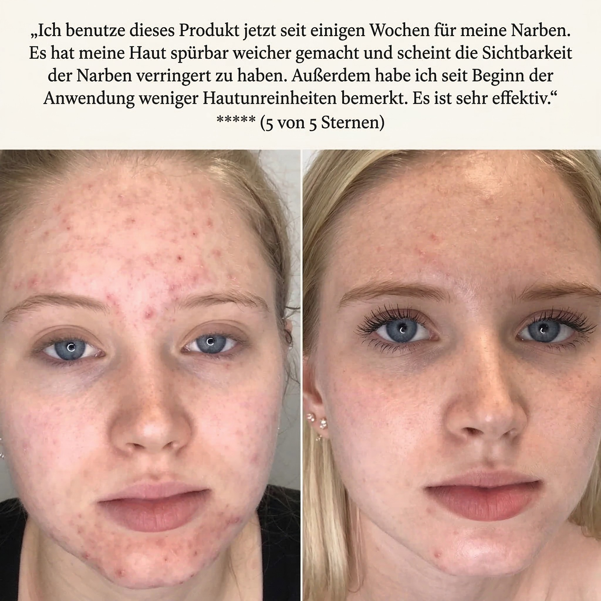 Lanvara Anti-Akne Blaulicht-Gerät für reinere Haut - Bild 19