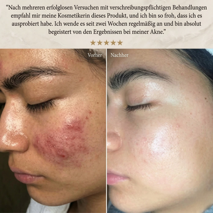 Lanvara Anti-Akne Blaulicht-Gerät für reinere Haut - Bild 6