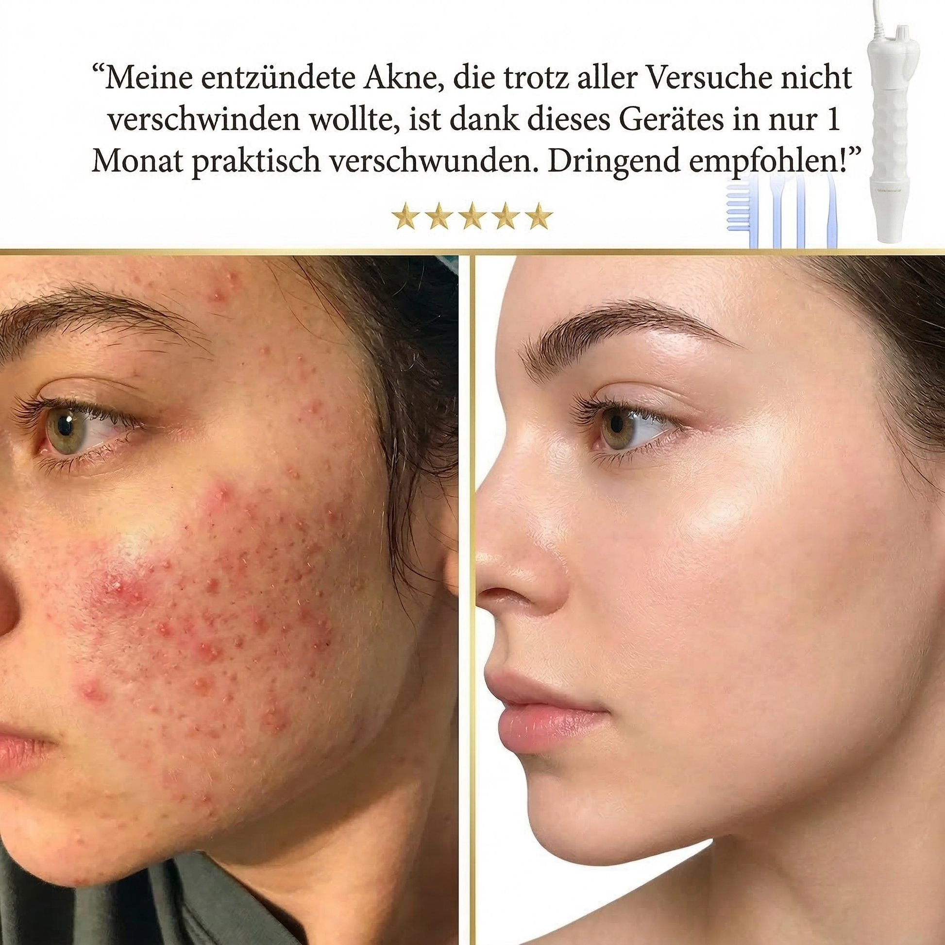 Lanvara Anti-Akne Blaulicht-Gerät für reinere Haut - Bild 2
